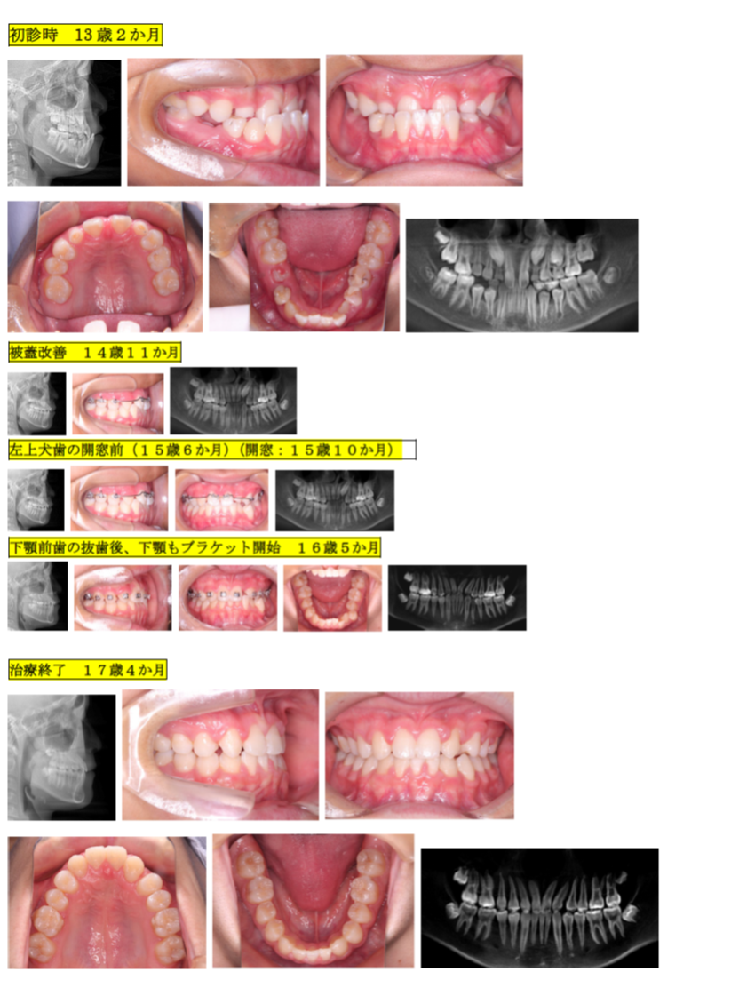 受け口(初診時13 歳男子：治療期間4年2か月目)