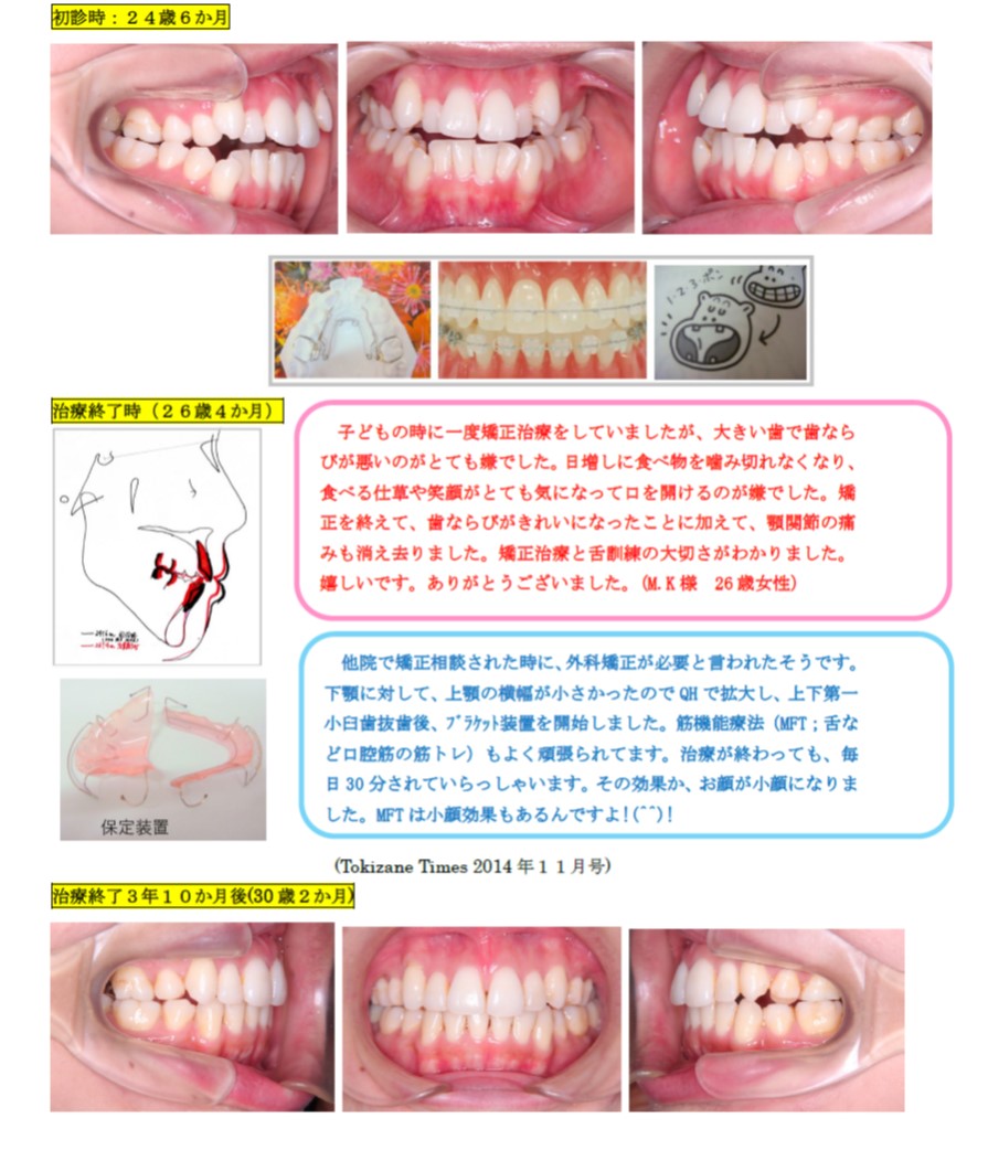 叢生＋開咬（抜歯症例）