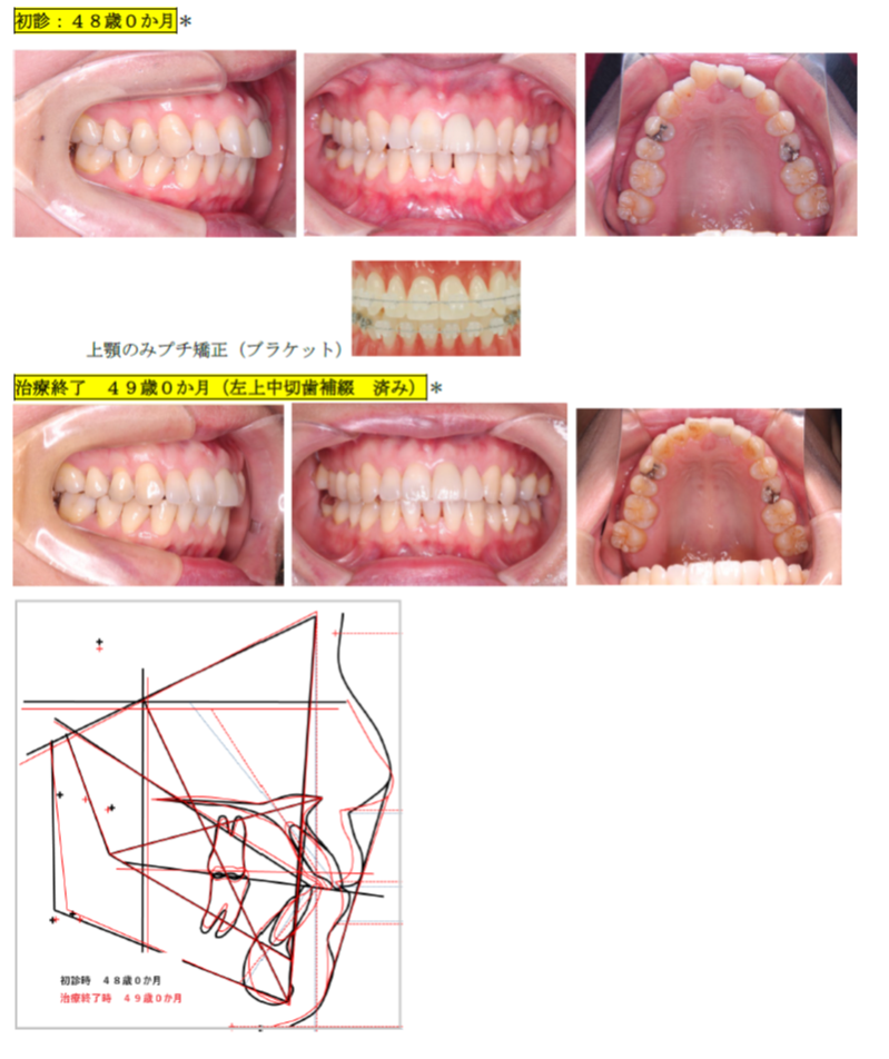 上顎前歯がでている（プチ矯正）