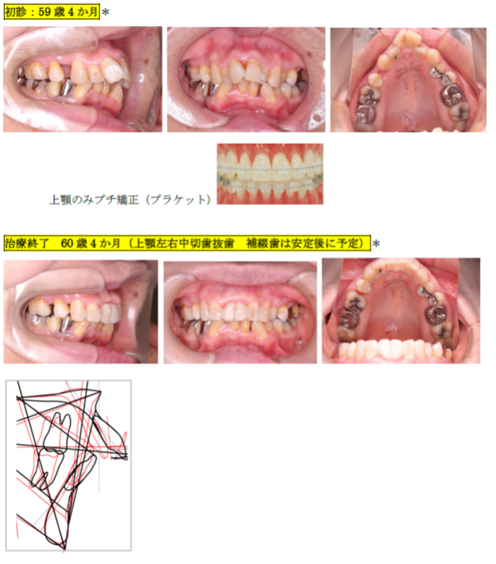 上顎前歯がでている（プチ矯正）