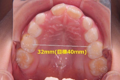 歯の矯正