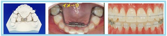歯の矯正