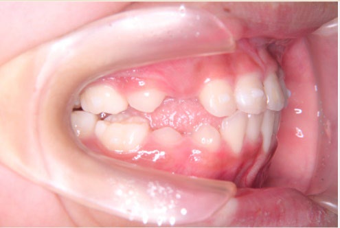 歯の矯正